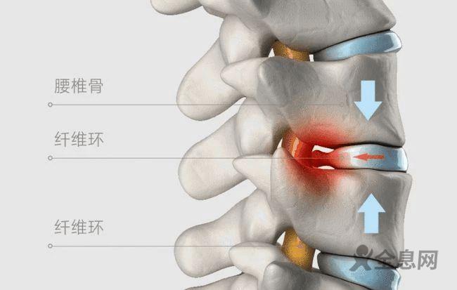 详解腰椎间盘突出症