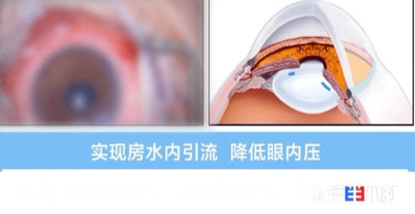国际首创！青光眼患者有了新希望！超千人已受益！